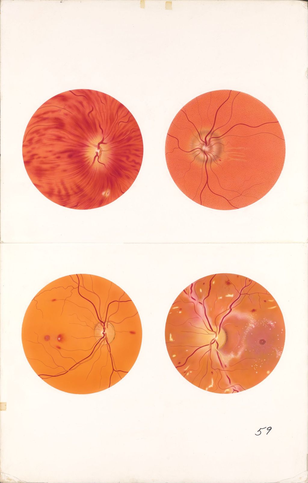 Miniature of Medical Profiles, Ophthalmoscopic Views In Various Diseases, Plate I