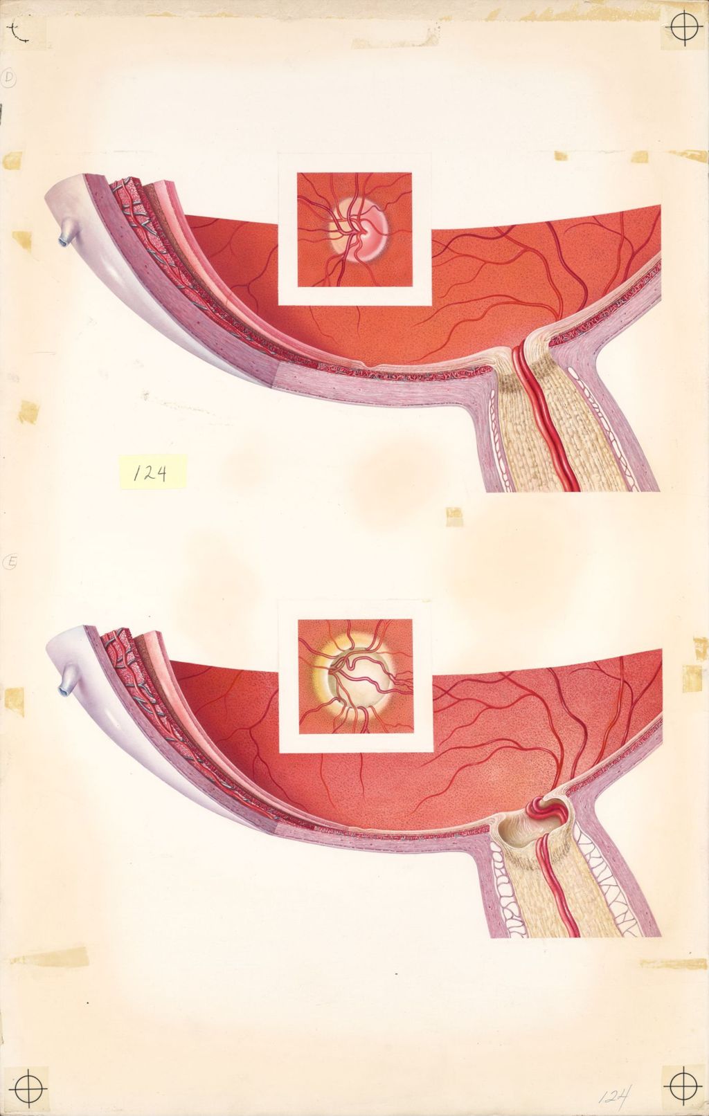 Medical Profiles, Glaucoma, Plate II, The Posterior Portion of the Eye