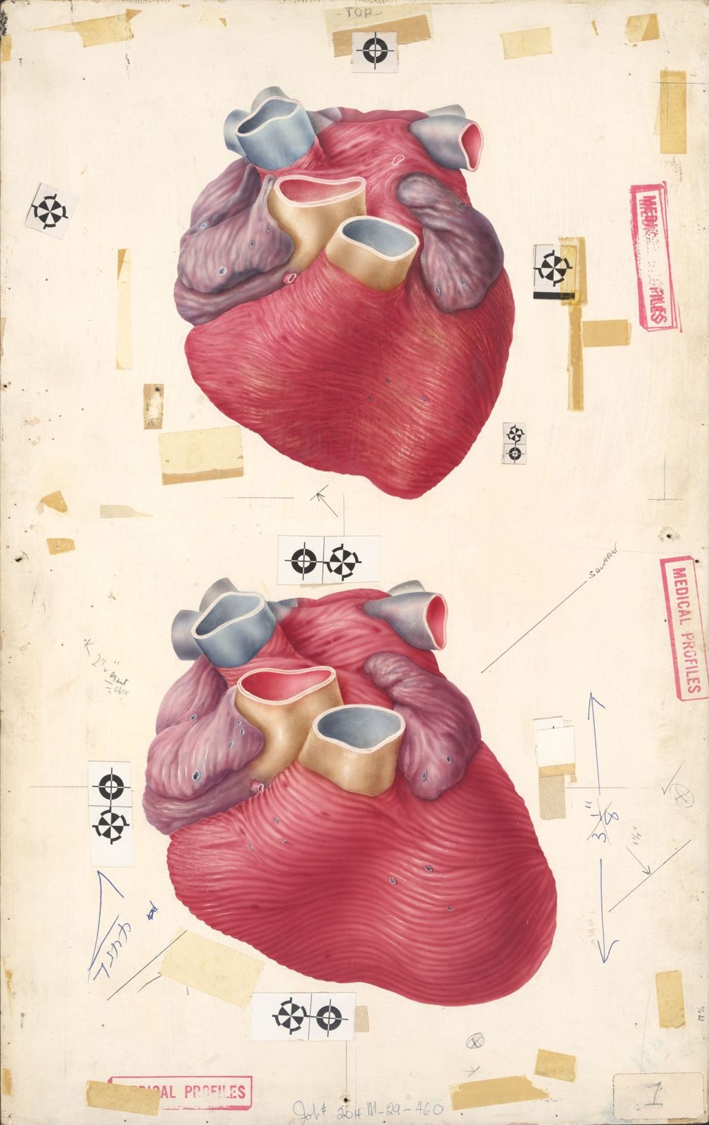 Miniature of Medical Profiles, Diupres and Hydropres, Hypertensive Heart Disease, Plate I