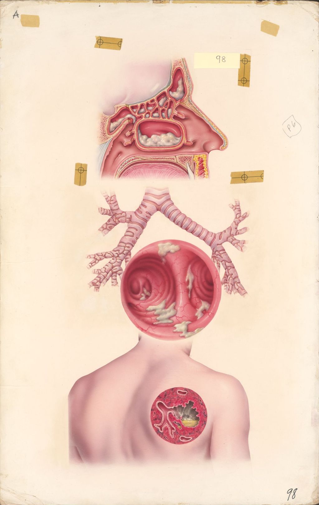 Miniature of Medical Profiles, Dornavac in various respiratory diseases, Plate I