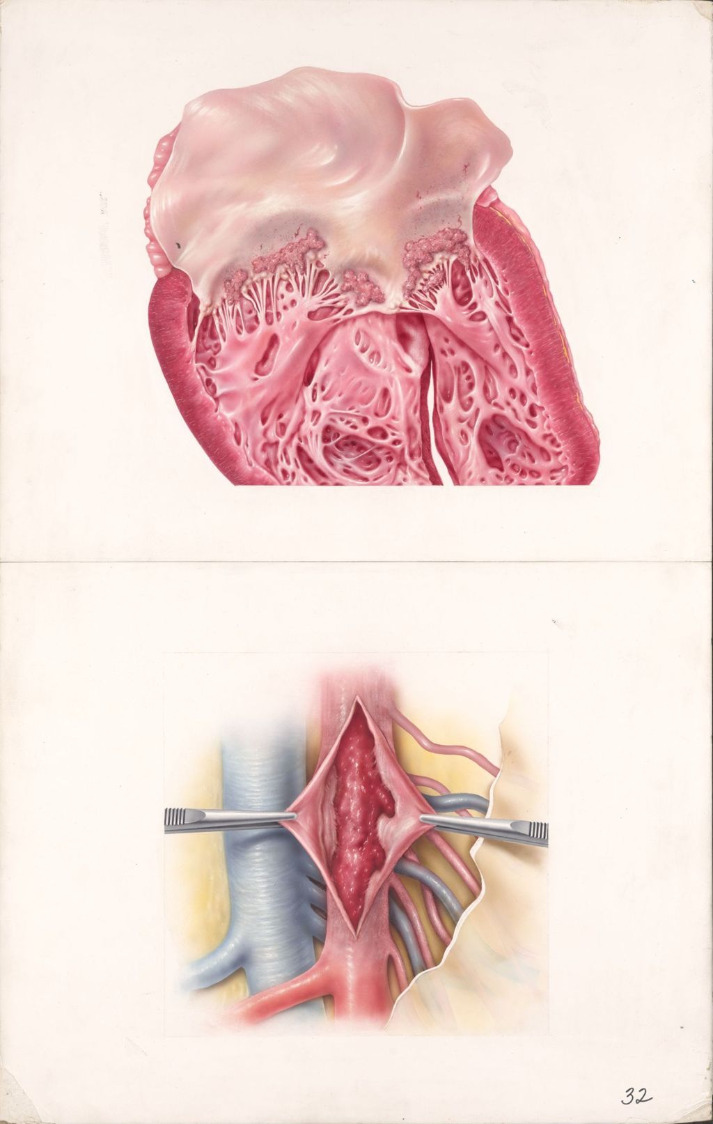 Miniature of Medical Profiles, Thrombolysin, Thrombosis and Embolism of the Superior Mesentric Artery, Plate II