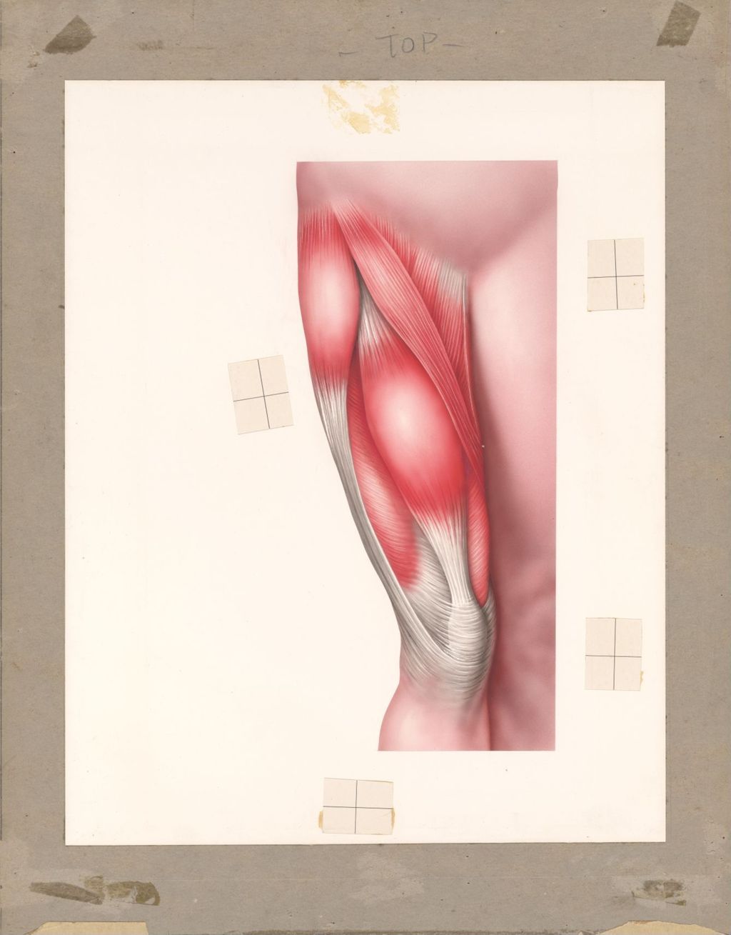 Miniature of Muscle Spasm