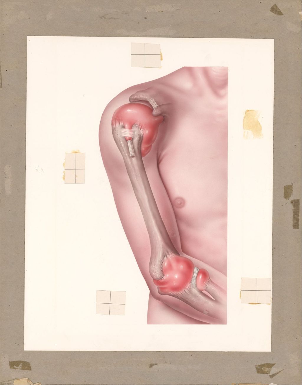 Miniature of Inflammation of Shoulder and Elbow Joints