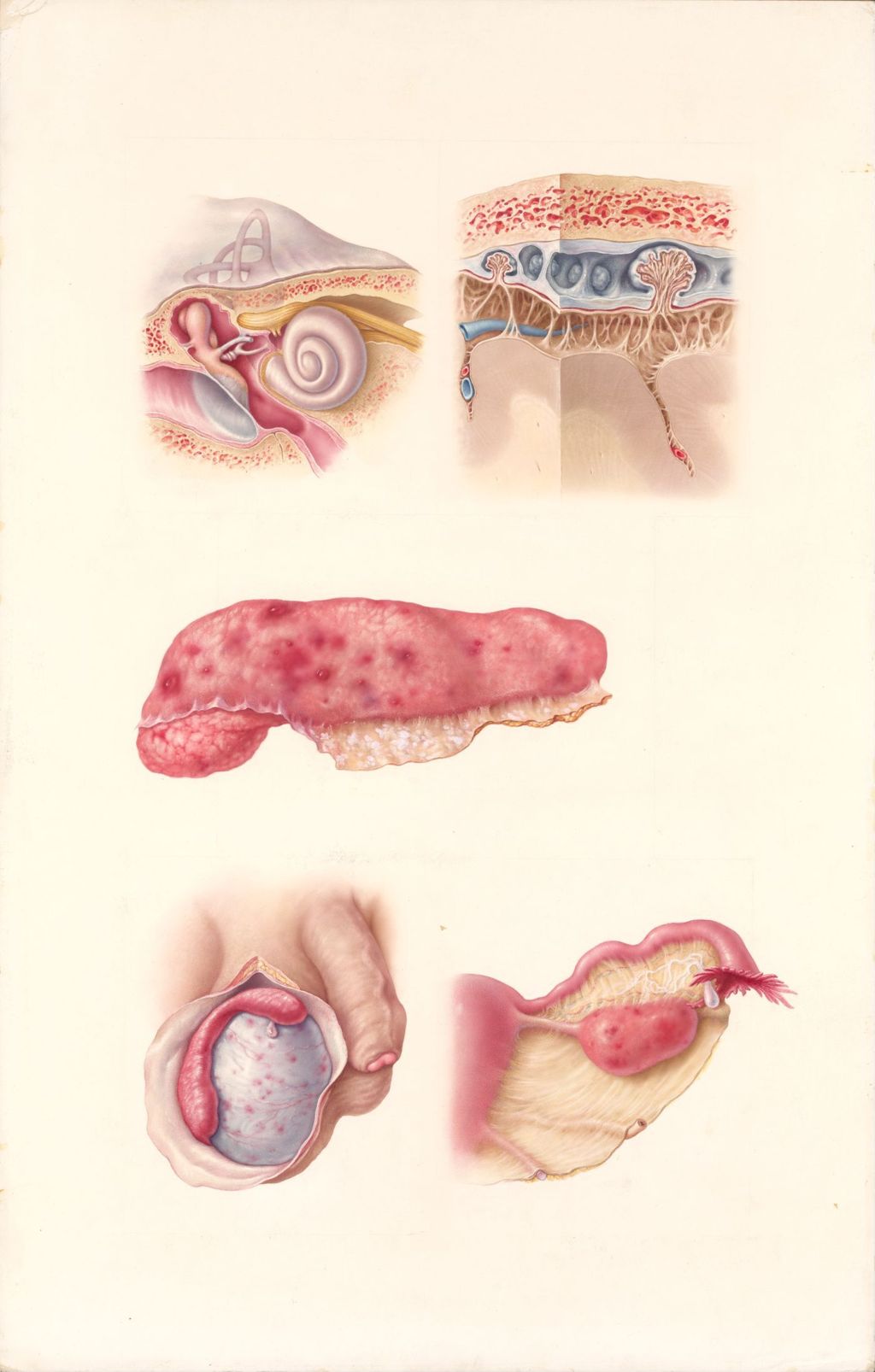 Miniature of Medical Profiles, The Effects of Mumps on Various Parts of the Body