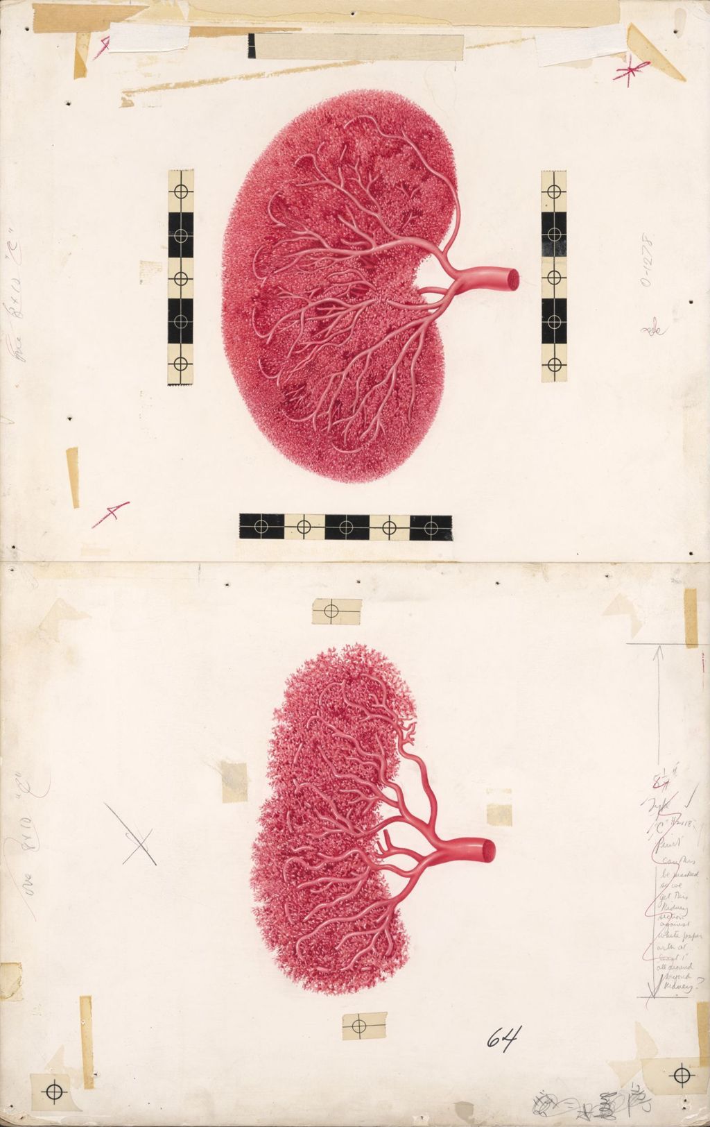Miniature of Medical Profiles, Sequellae of Hypertension, Hydropres, Kidney in Hypertension, Plate II
