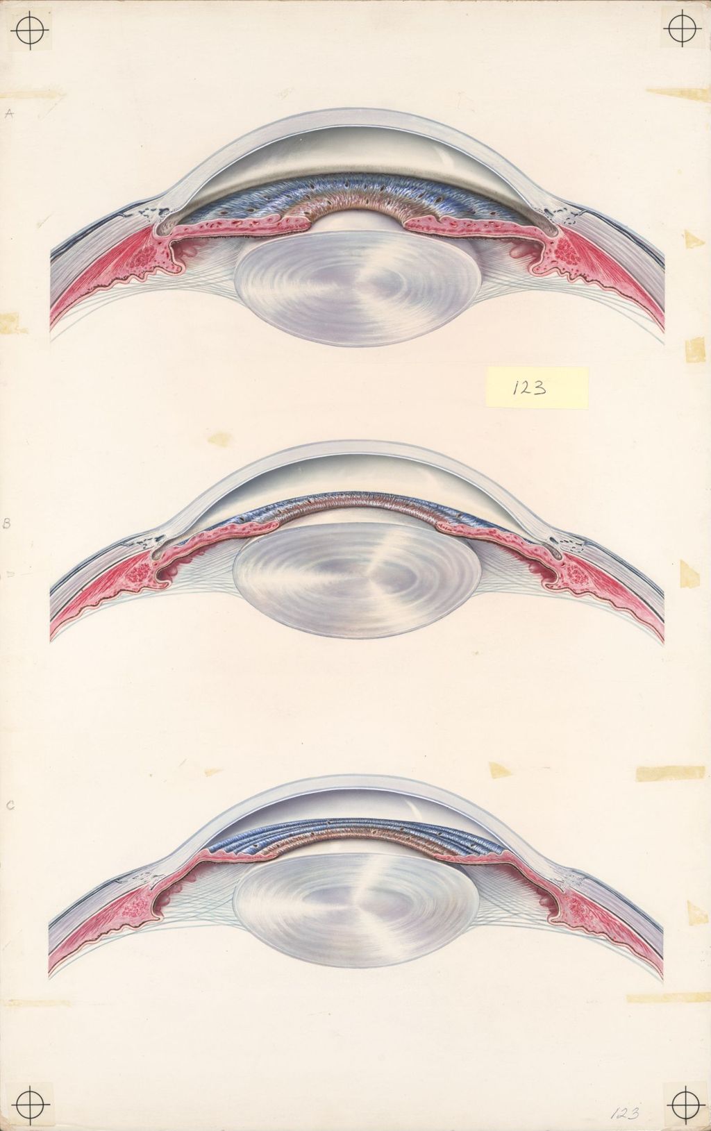 Medical Profiles, Glaucoma, Plate I, The Anterior Portion of the Eye