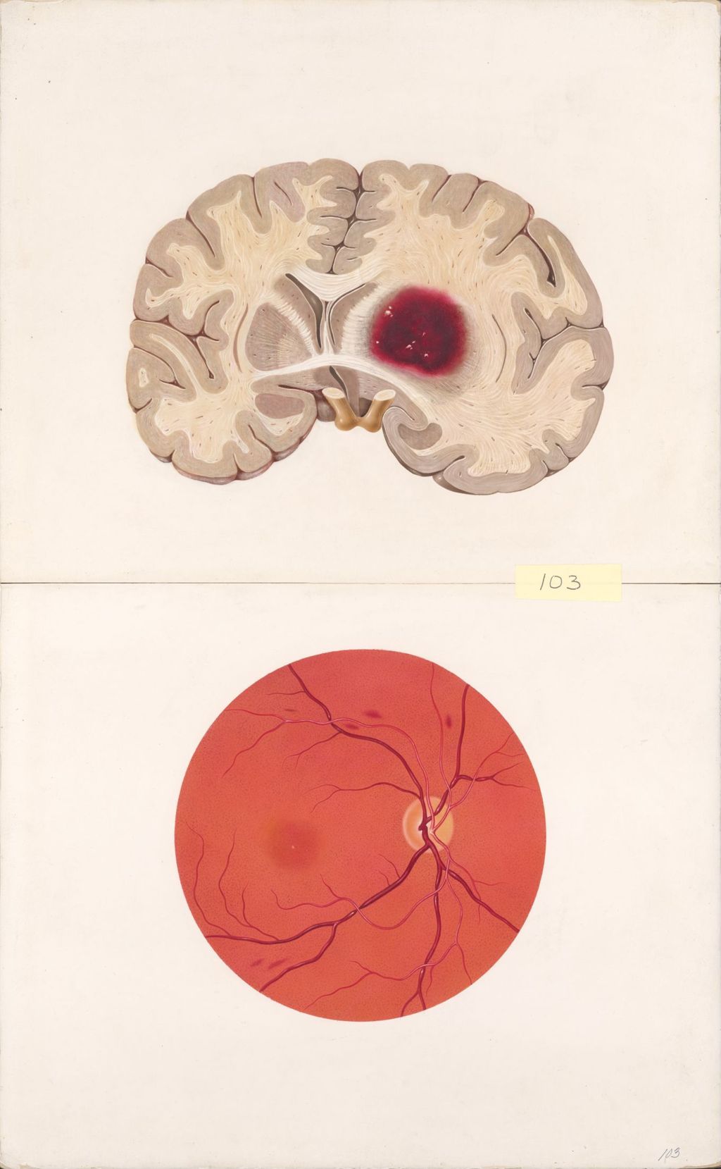 Miniature of Medical Profiles, Hydropres, Hypertension in the Brain and Fundus, Plate III