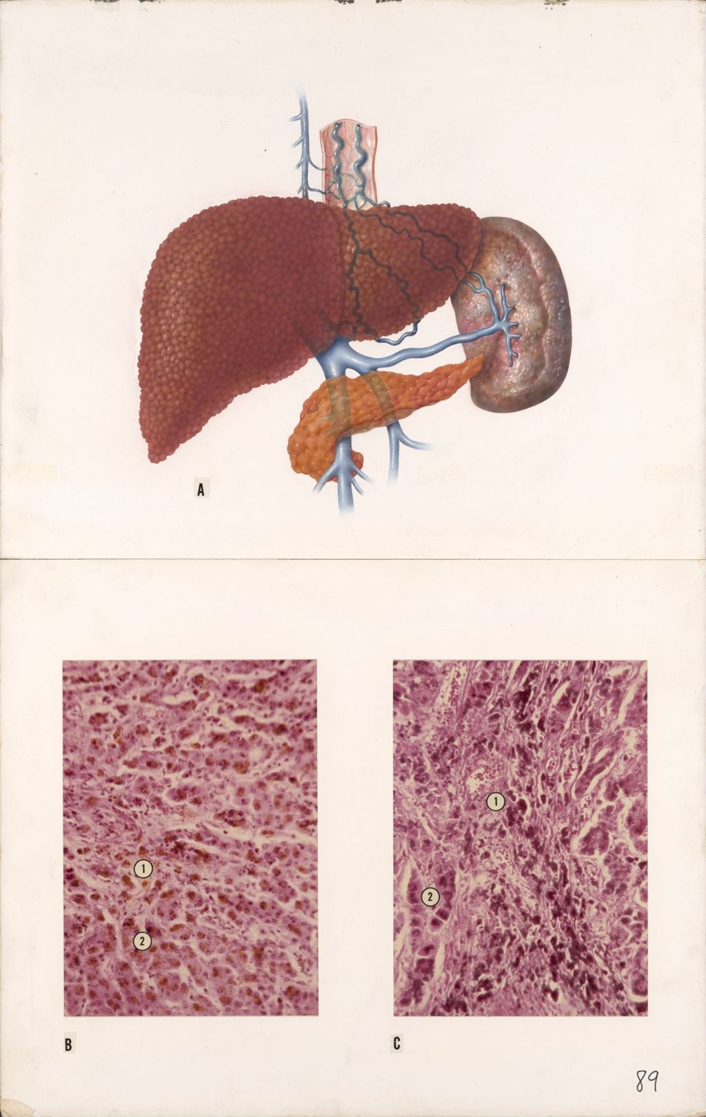 Medical Profiles, Ascites in Portal Hypertension (Diuril-Hydrodiuril), Plate II