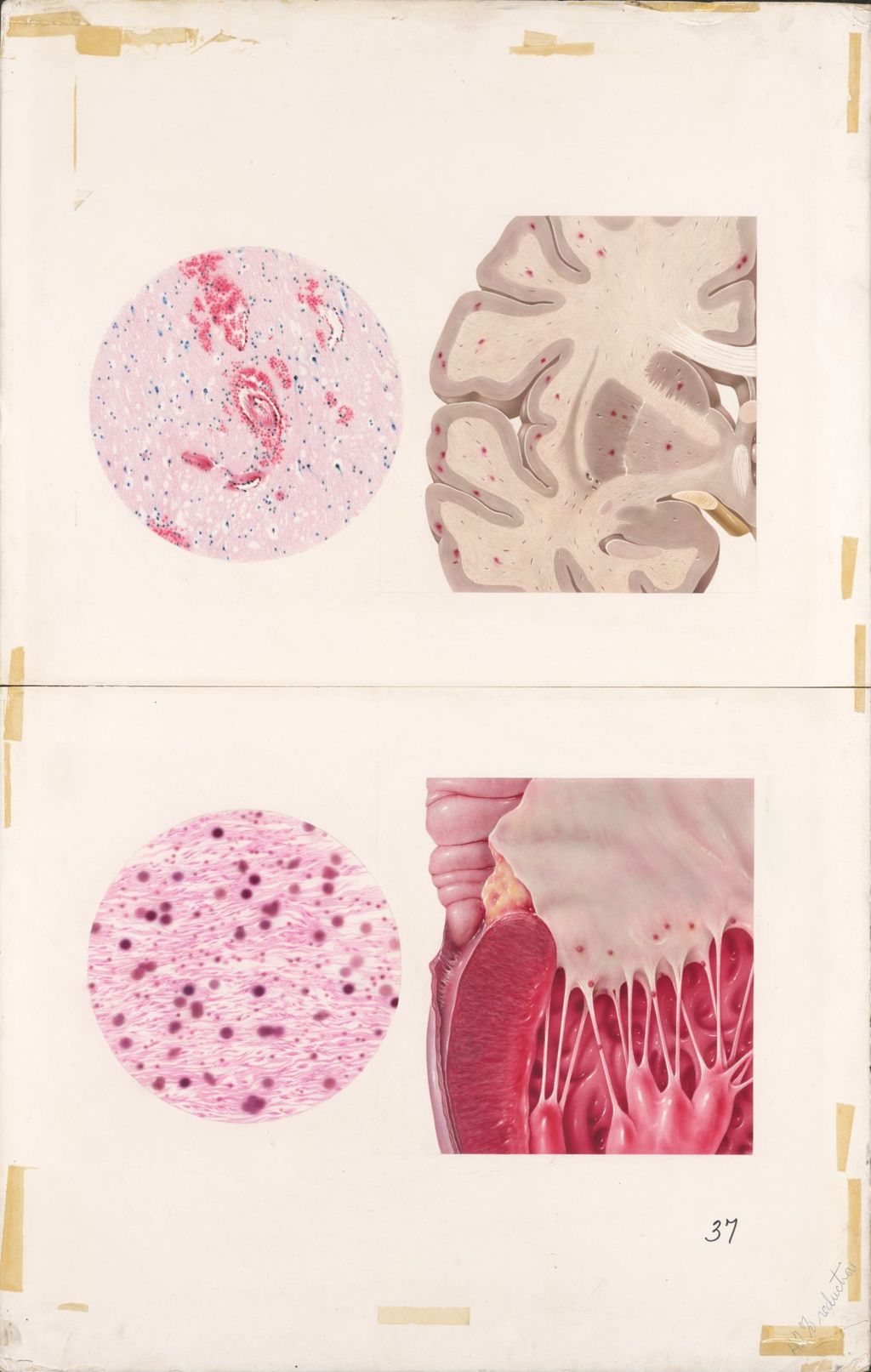 Medical Profiles, Lupus Erythematosus, Decadron, Plate II