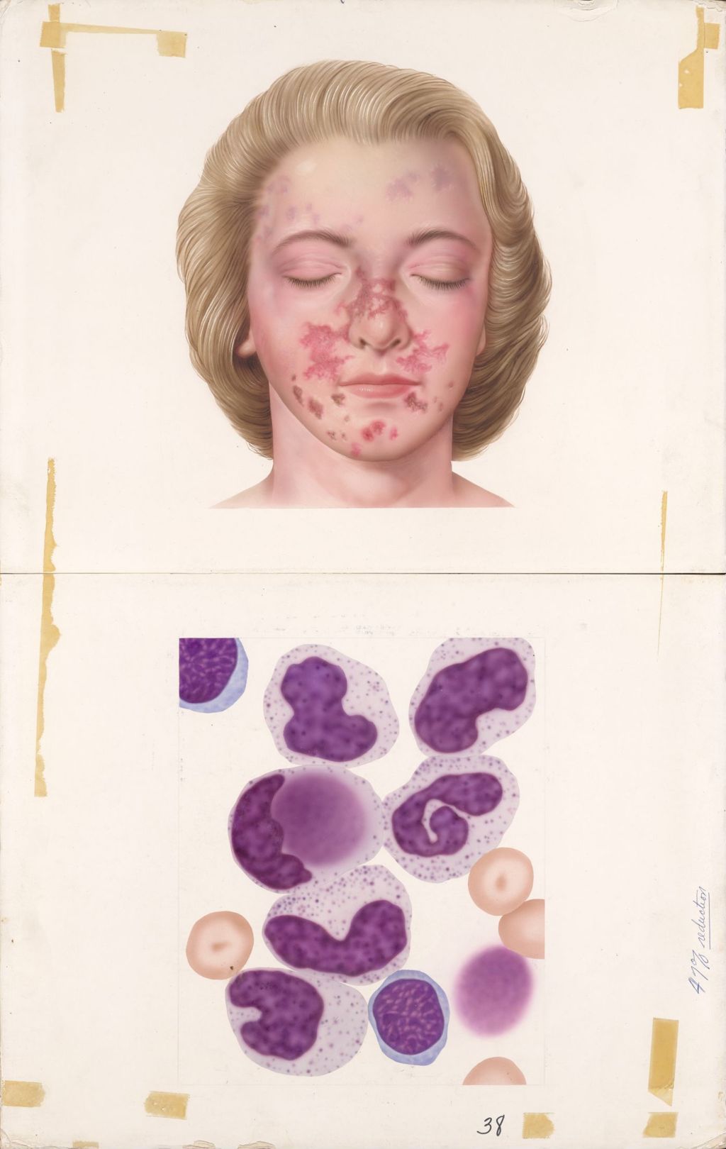 Miniature of Medical Profiles, Lupus Erythematosus, Decadron, Plate I