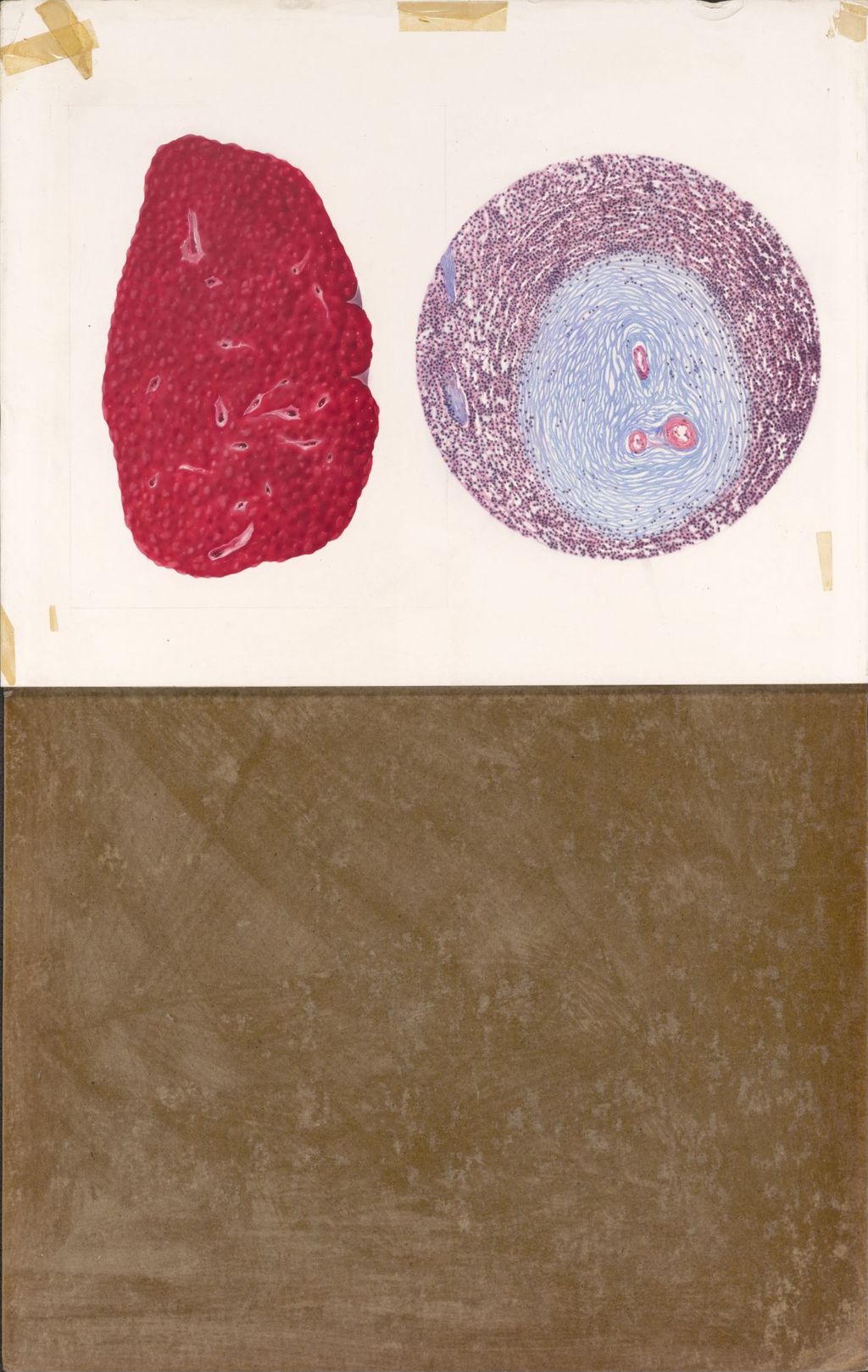 Medical Profiles, Lupus Erythematosus, Decadron, Plate III