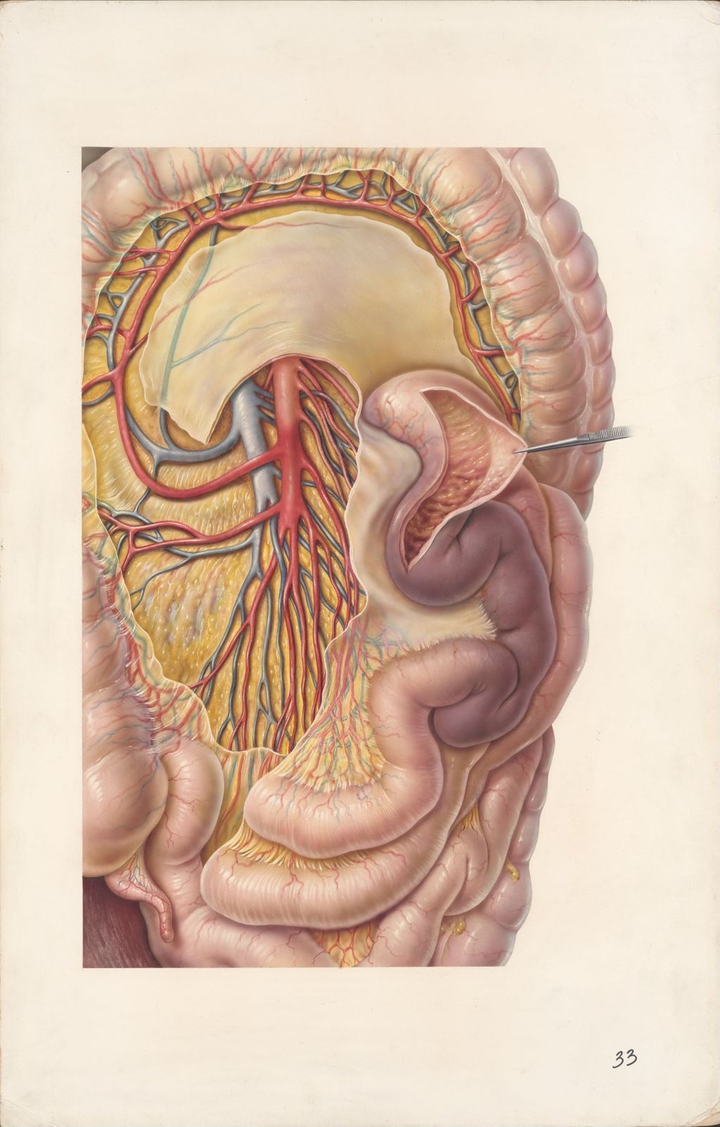 Medical Profiles, Thrombolysin, Thrombosis and Embolism of the Superior Mesenteric Artery, Plate I