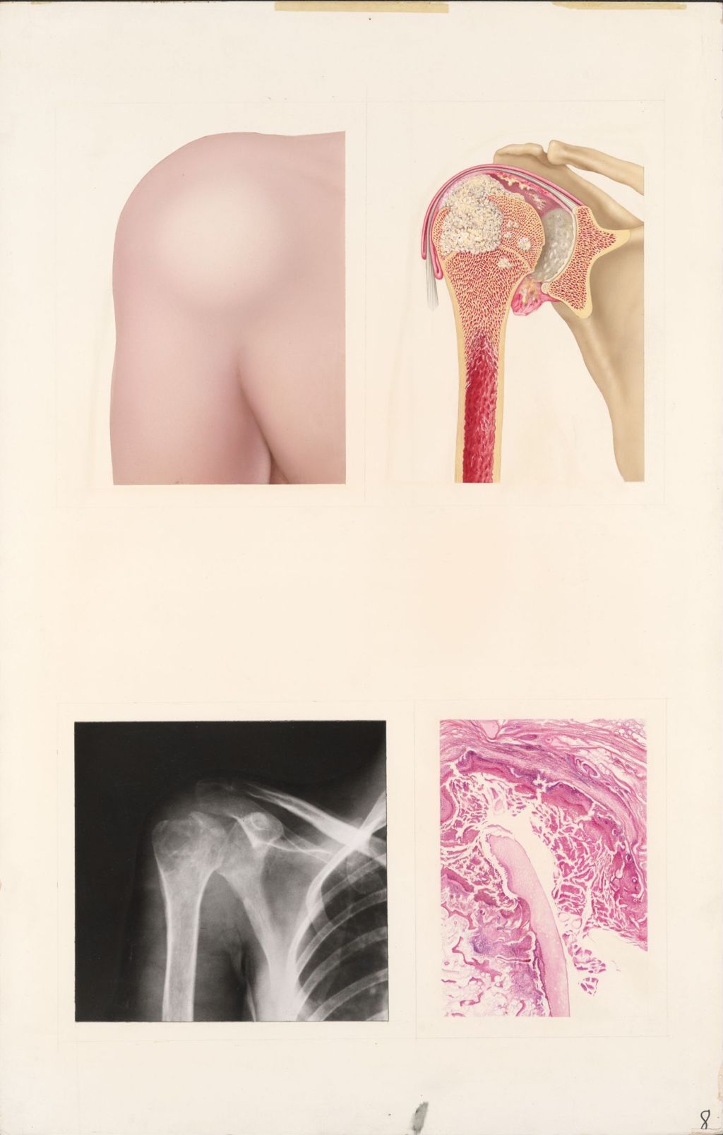 Medical Profiles, Comparison of Four Common Types of Arthritis, Plate IV, Tuberculous Arthritis