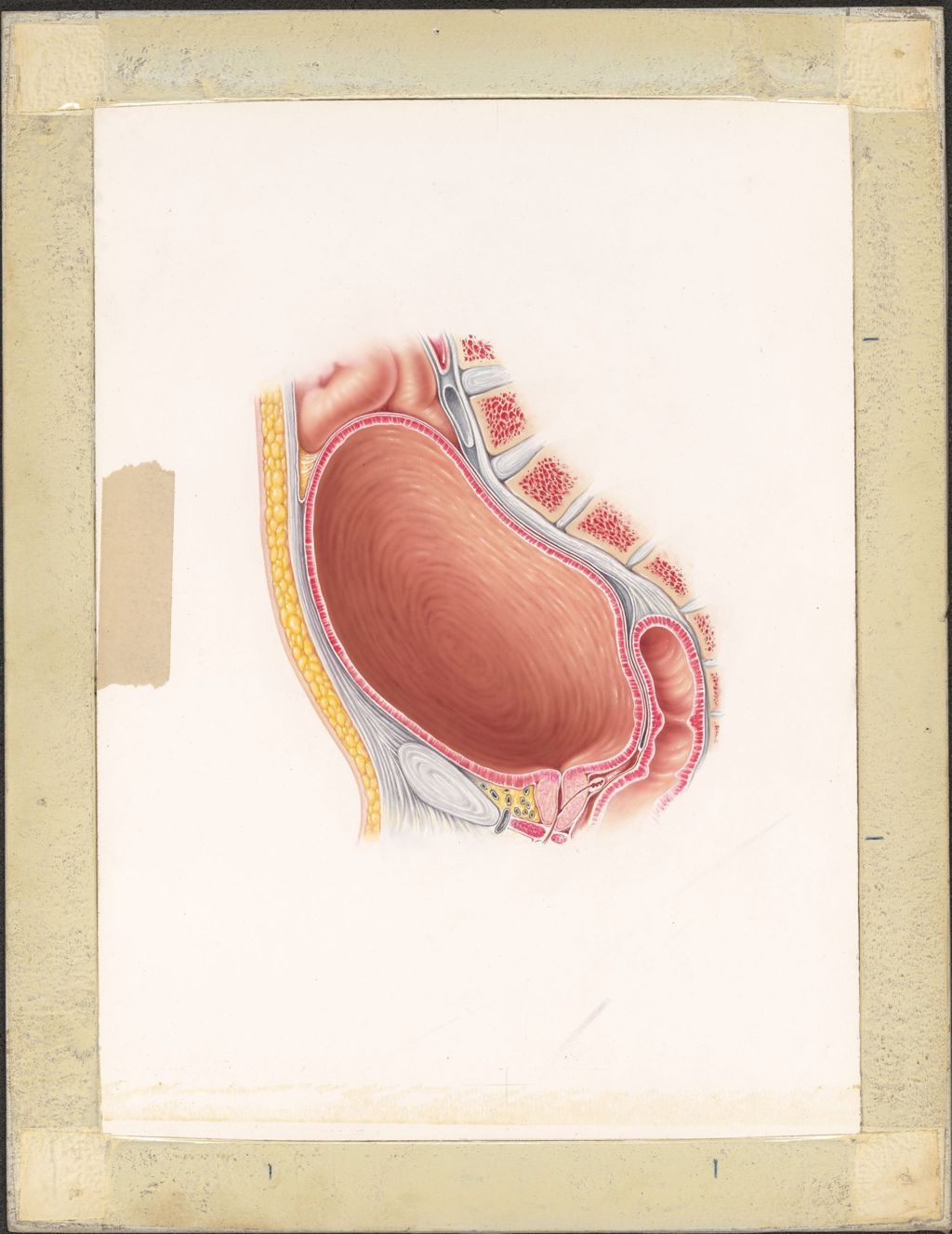 Miniature of Distended Bladder, Urinary Retention