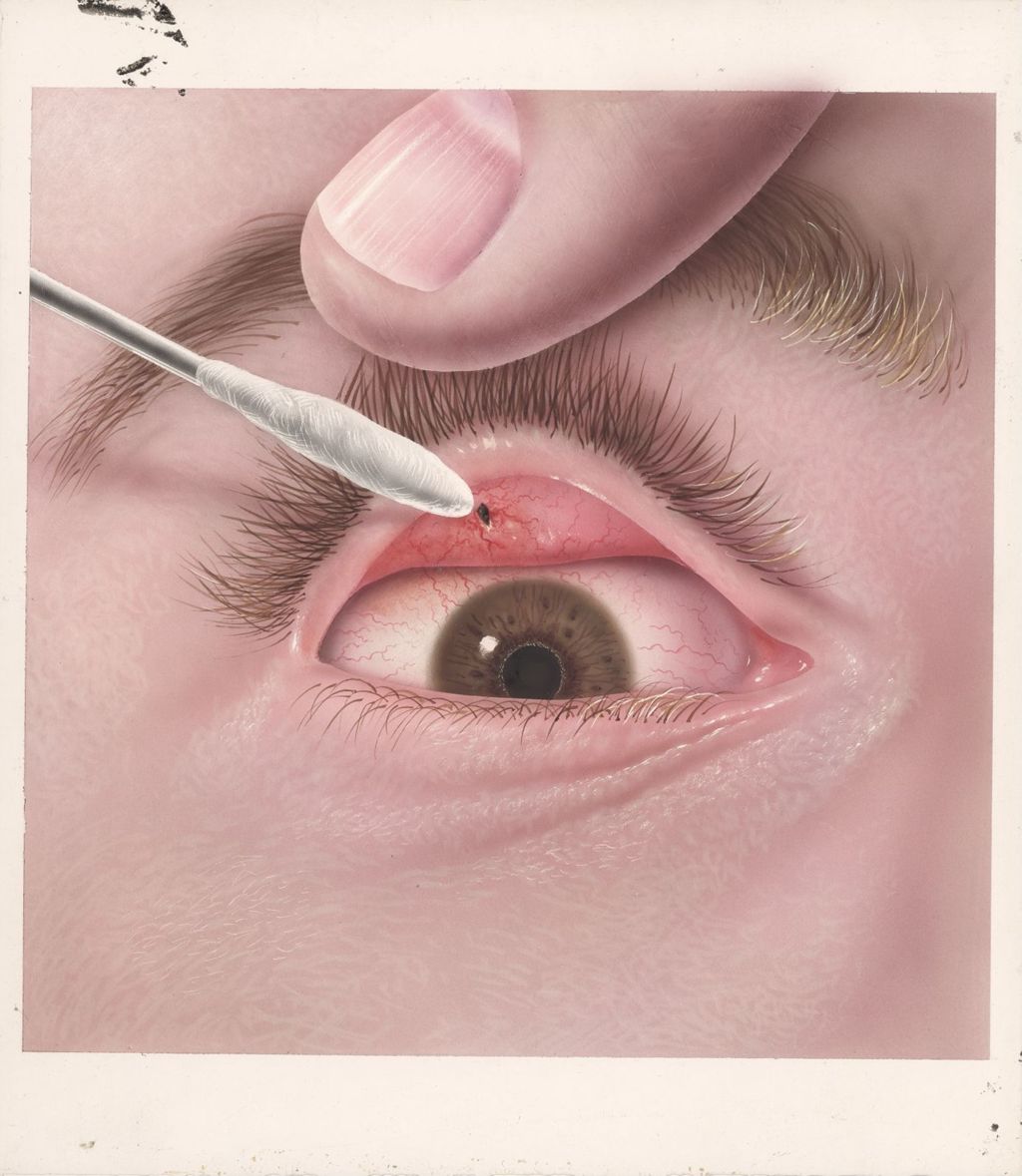 Miniature of Foreign bodies in the conjunctival sac
