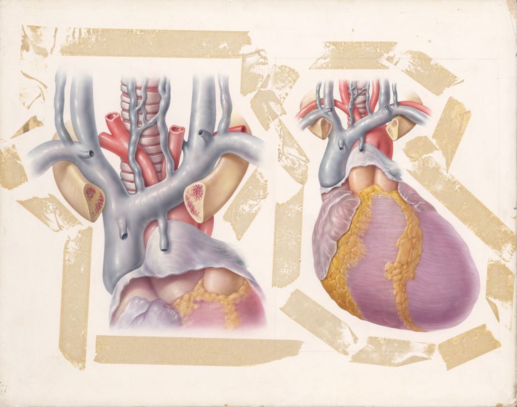 Edema of Cardiac Origin, Diuril-Hydrodiuril, Hypertensive Heart Disease
