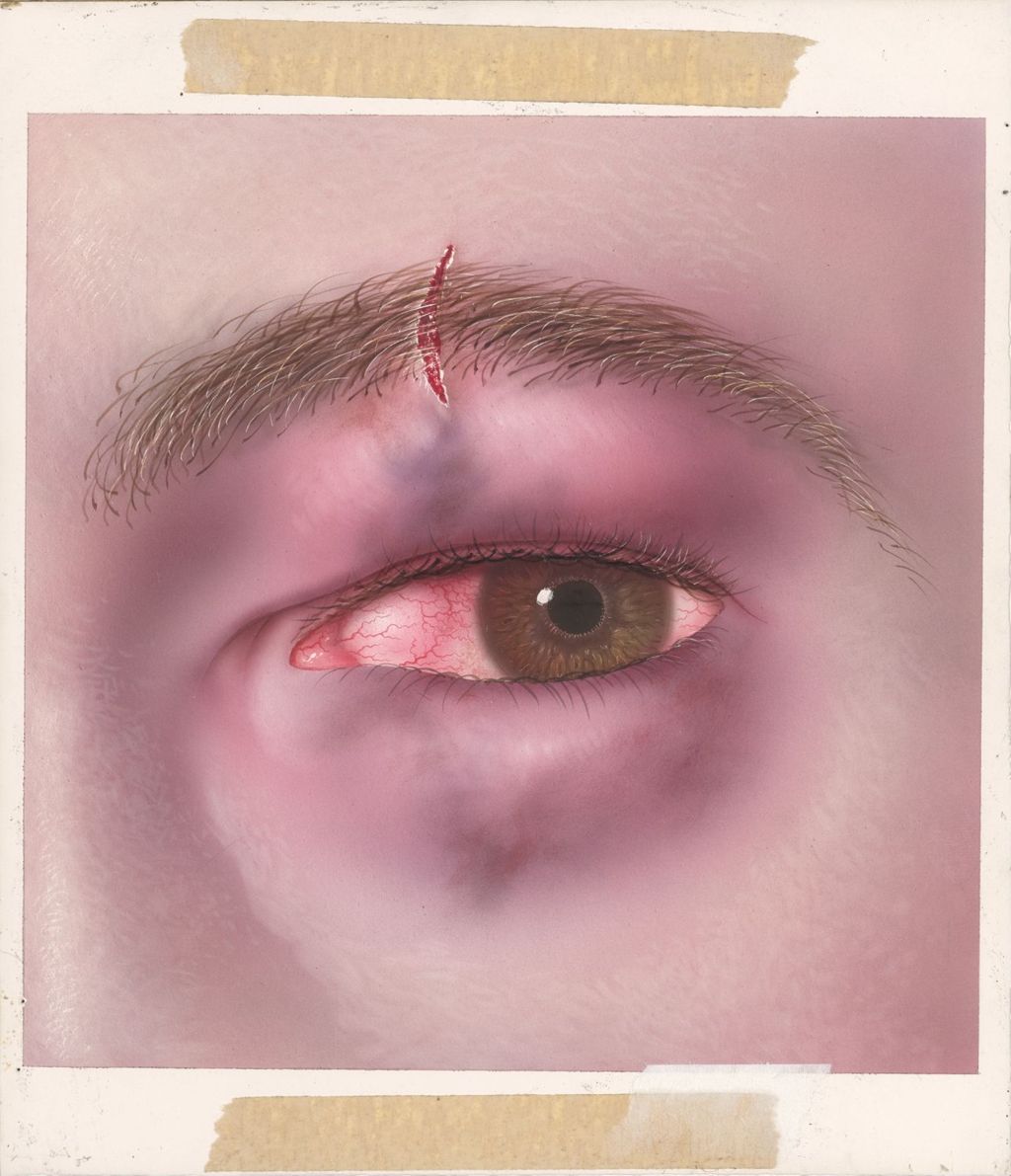 Miniature of Injuries of the eyelids and conjunctiva and non-penetrating injuries to the orbit, cornea and sclera