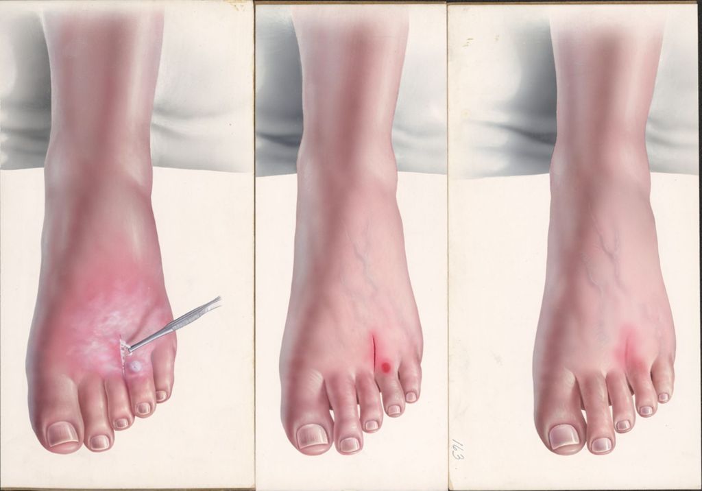 Miniature of Medical Profiles, Staphylococcic Abscess With Secondary Tenosynovitis, Dornavac, Plate II
