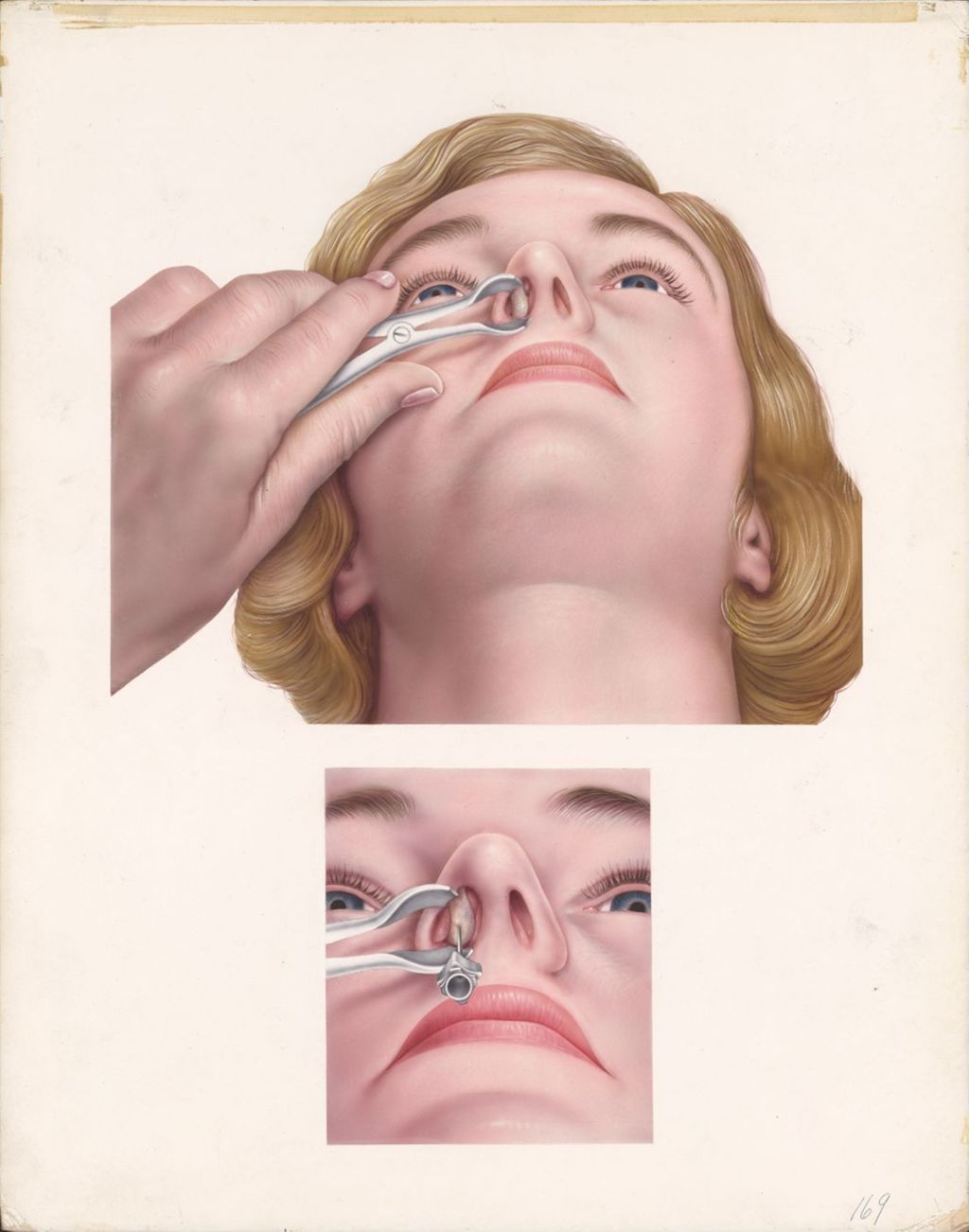 Miniature of Medical Profiles, Hydeltra TBA, Nasal Polypi, Plate II