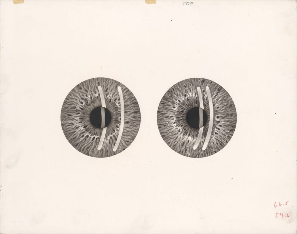 Miniature of Light Reflex on Cornea and Iris of Normal Anterior Chamber, Contrasted with Similar Light Reflex on Shallow Anterior Chamber