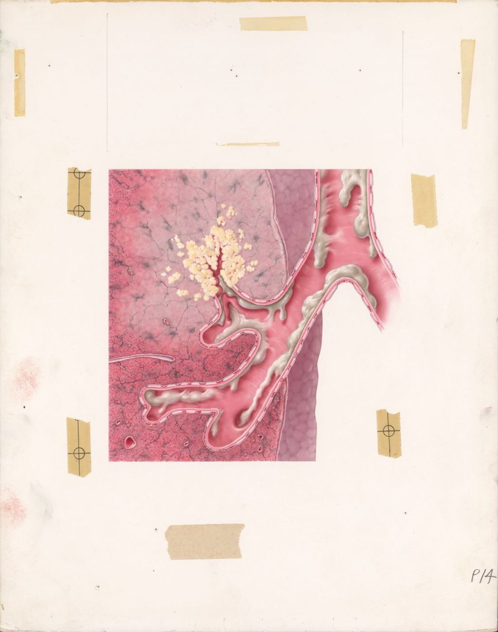 Miniature of Dornavac, Bronchogenic Carcinoma