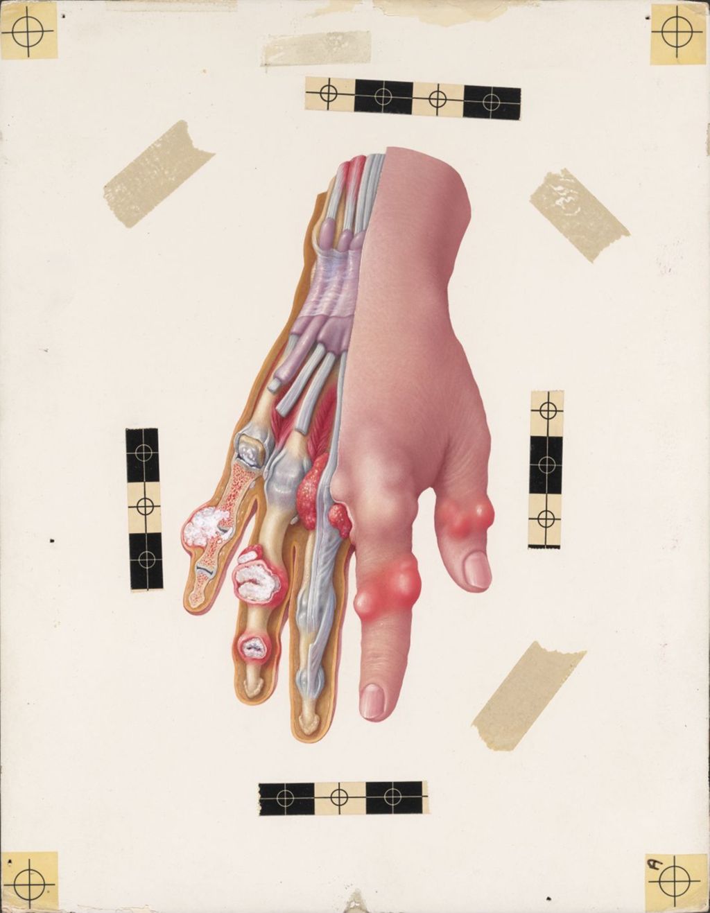 Miniature of Aspects of Gout in a hand