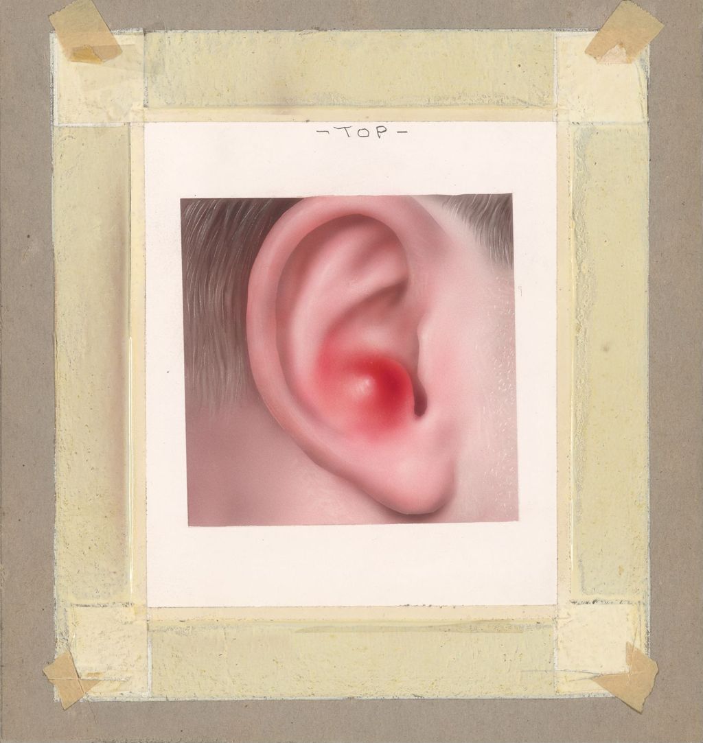 Miniature of Abscess of the External Ear