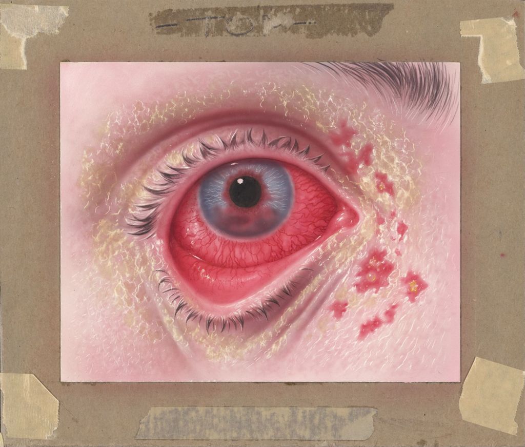 Miniature of Case of Herpes Zoster Ophthalmicus with Keratitis and Severe Uveitis