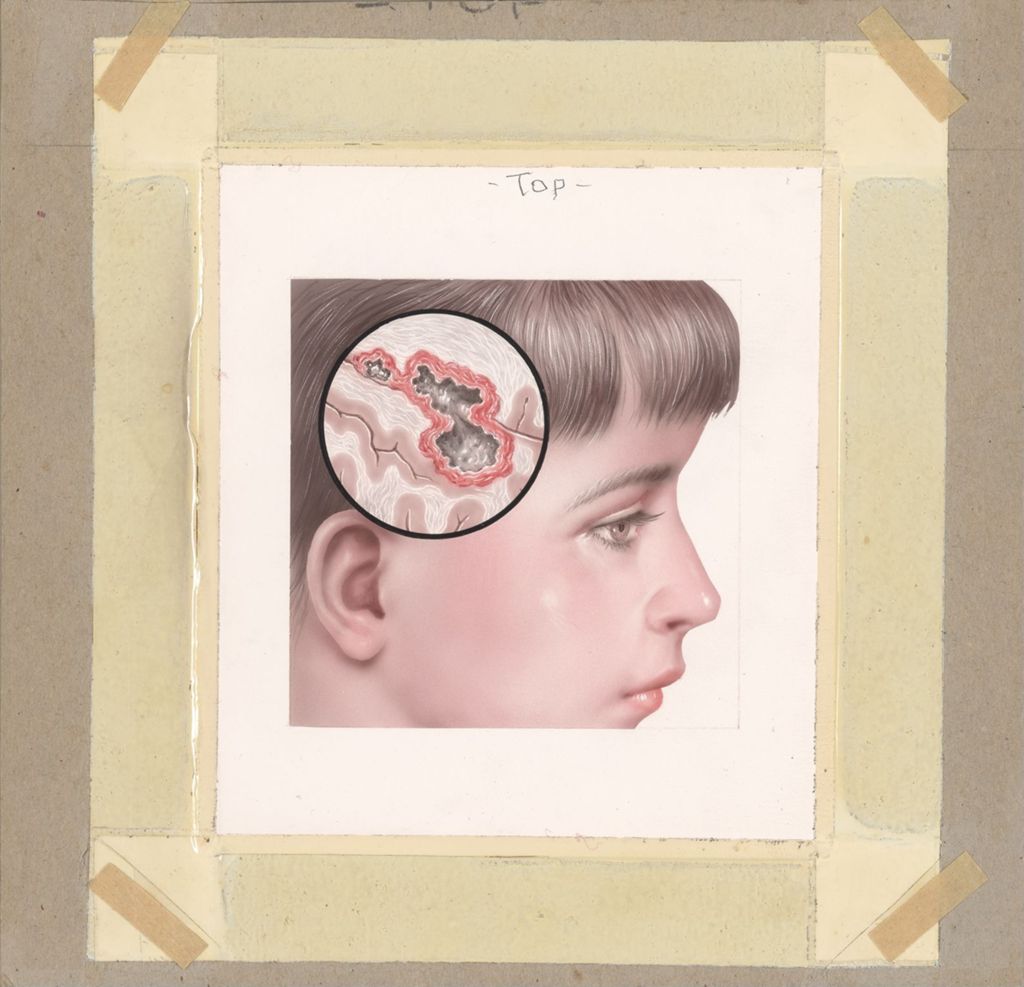 Miniature of Brain Abscess in a Child