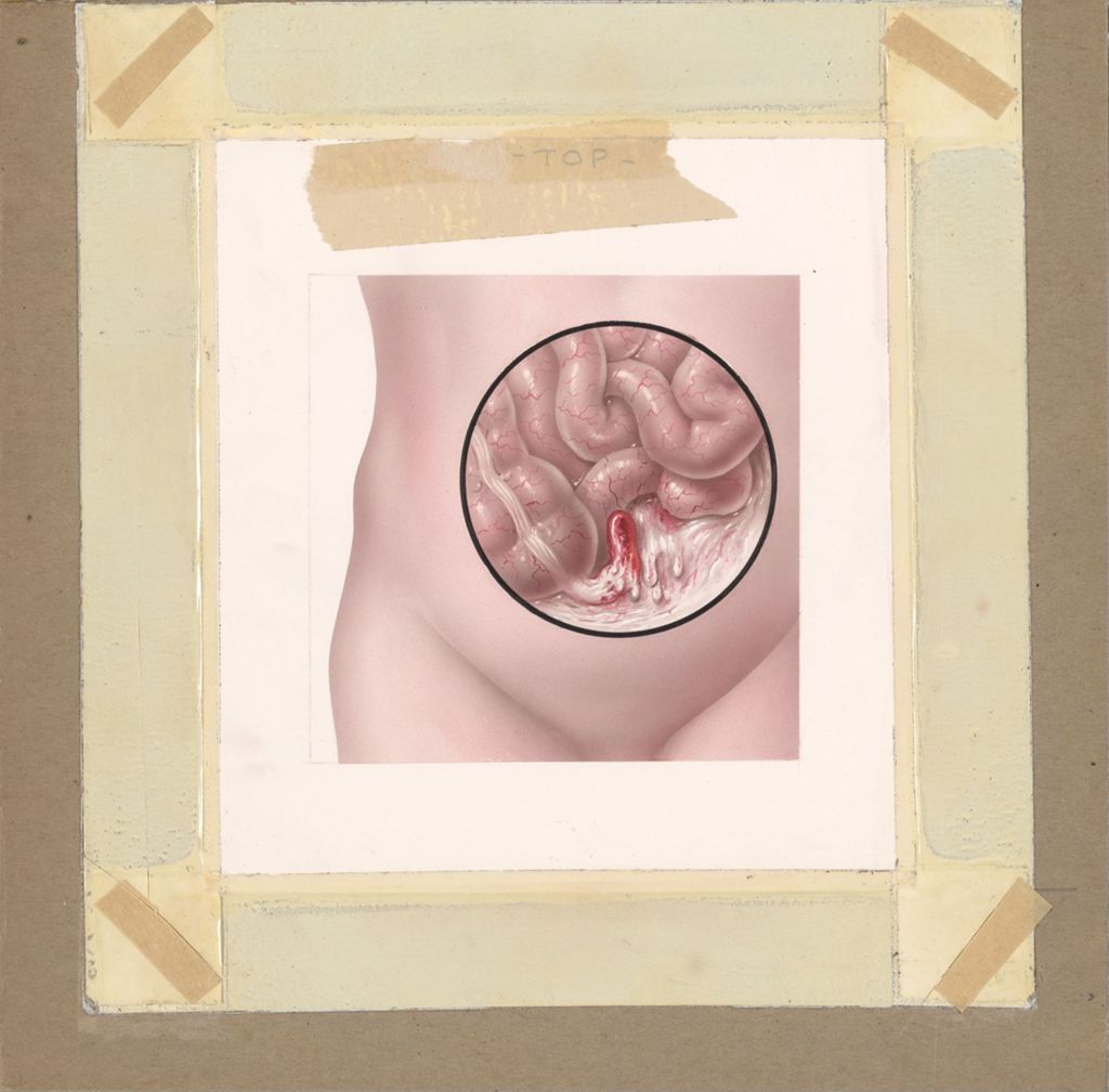 Miniature of Staphylococcic Septicemia and Enteritis