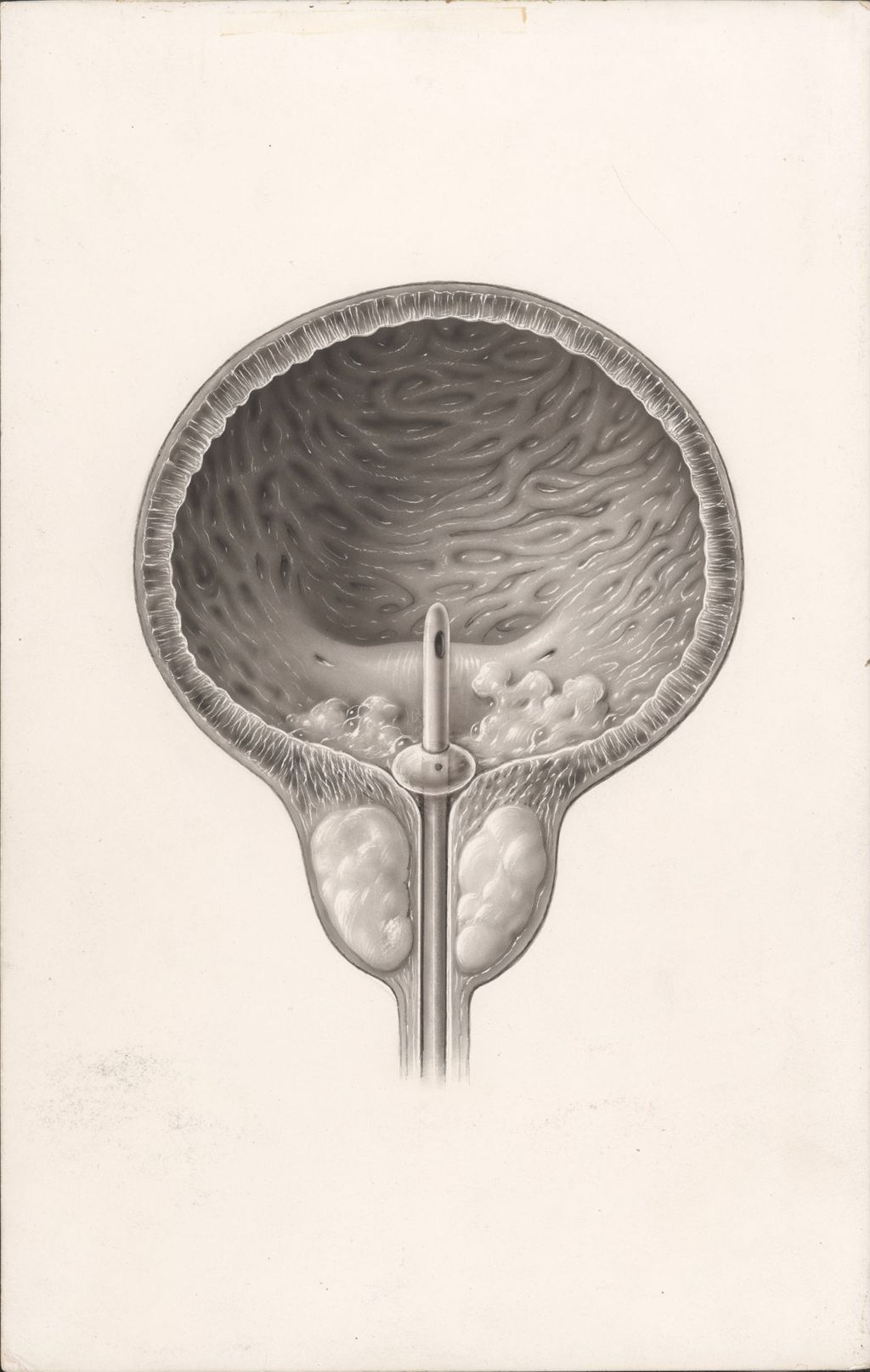 Miniature of Dornavac, Purulent Urologic Condition, Indwelling Urethral Catheter