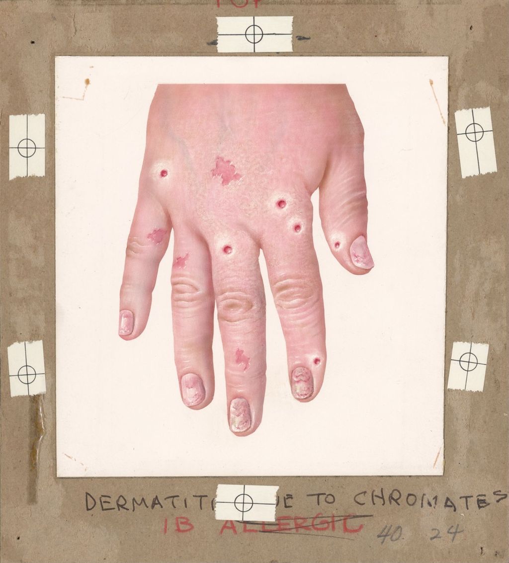 Miniature of Handbook on Common Dermatological Problems, Contact Dermatitis, Dermatitis Caused By Chromates
