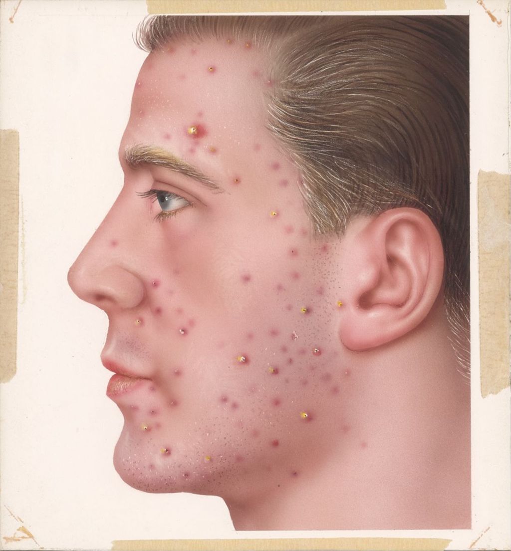 Miniature of Handbook on Common Dermatological Problems, Acne