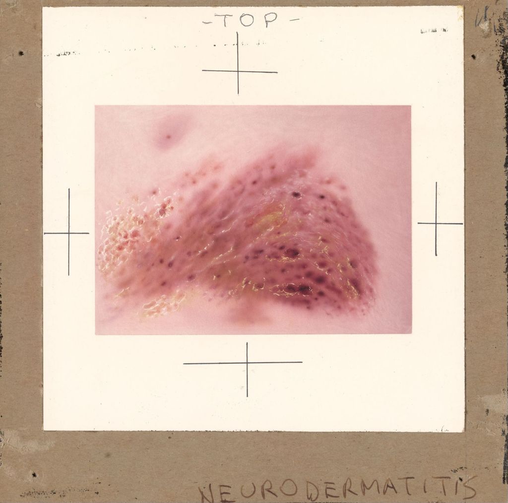 Miniature of Neurodermatitis, Decadron