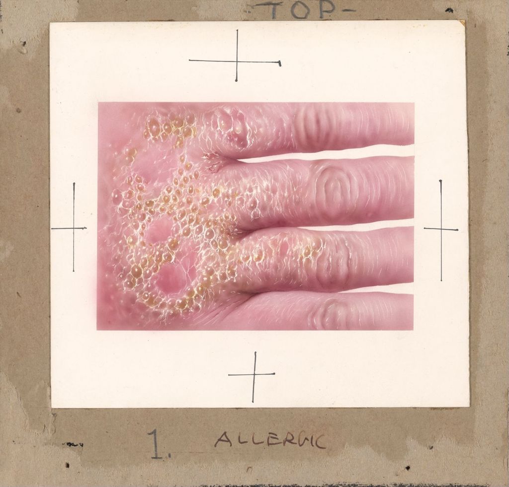 Miniature of Allergic Dermatitis, Decadron