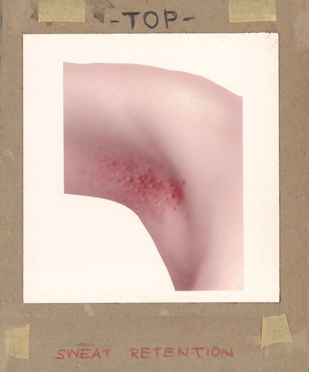 Miniature of Handbook on Common Dermatological Problems, Underarm Showing Sweat Retention Syndrome