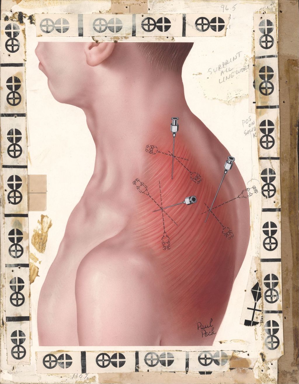 Miniature of Hydeltra, Artwork of man's shoulder showing needle insertion points