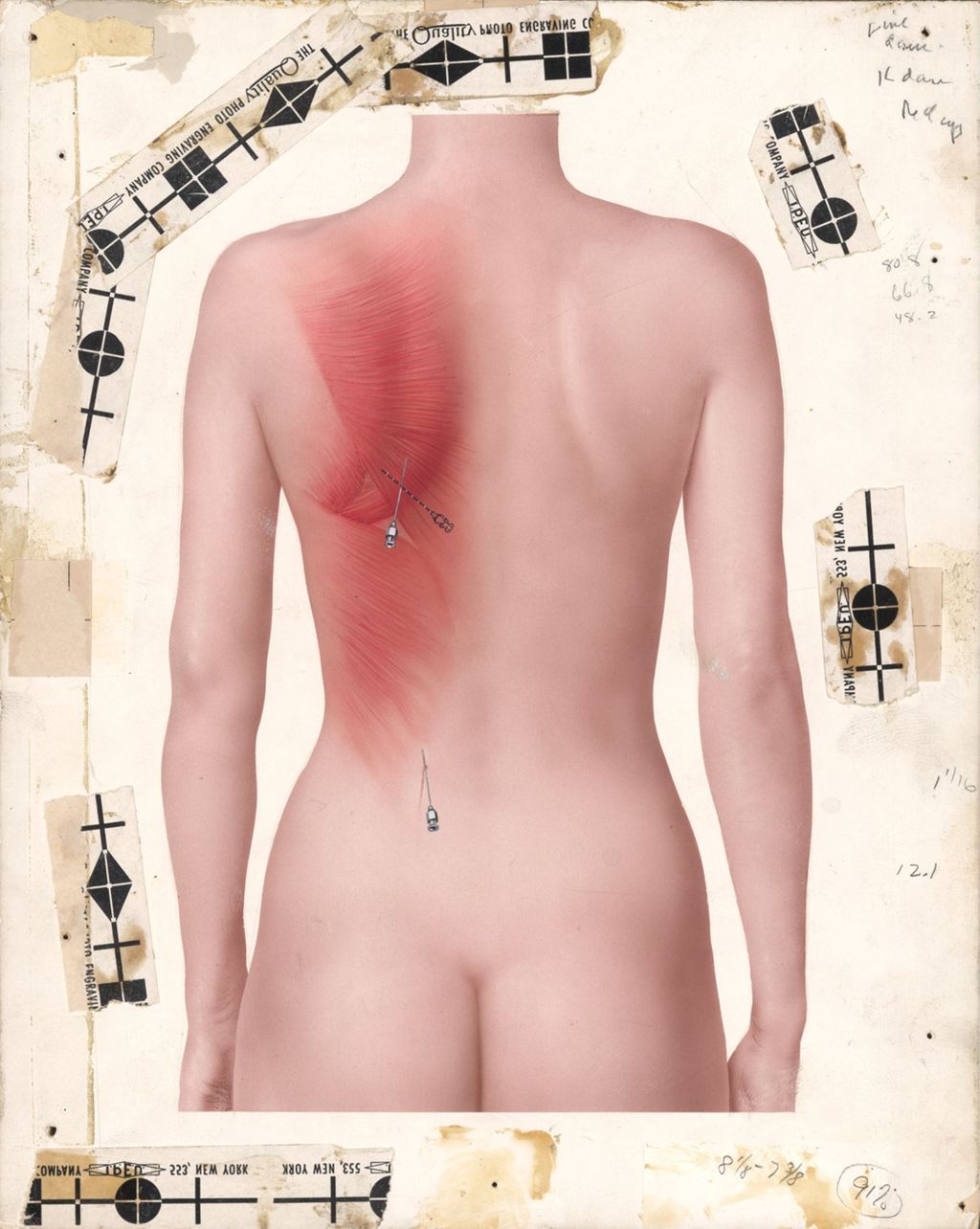 Miniature of Hydeltra, Artwork of woman's back showing needle insertion points under shoulder and lower back
