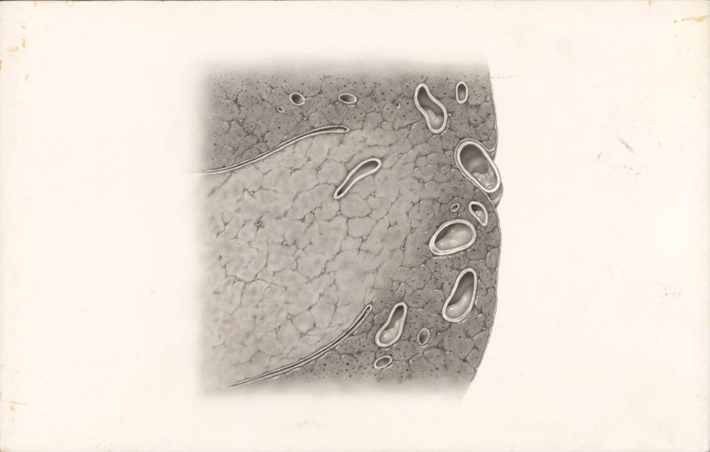 Miniature of Dornavac, Bronchopulmonary Infection, Unresolved Pneumonia