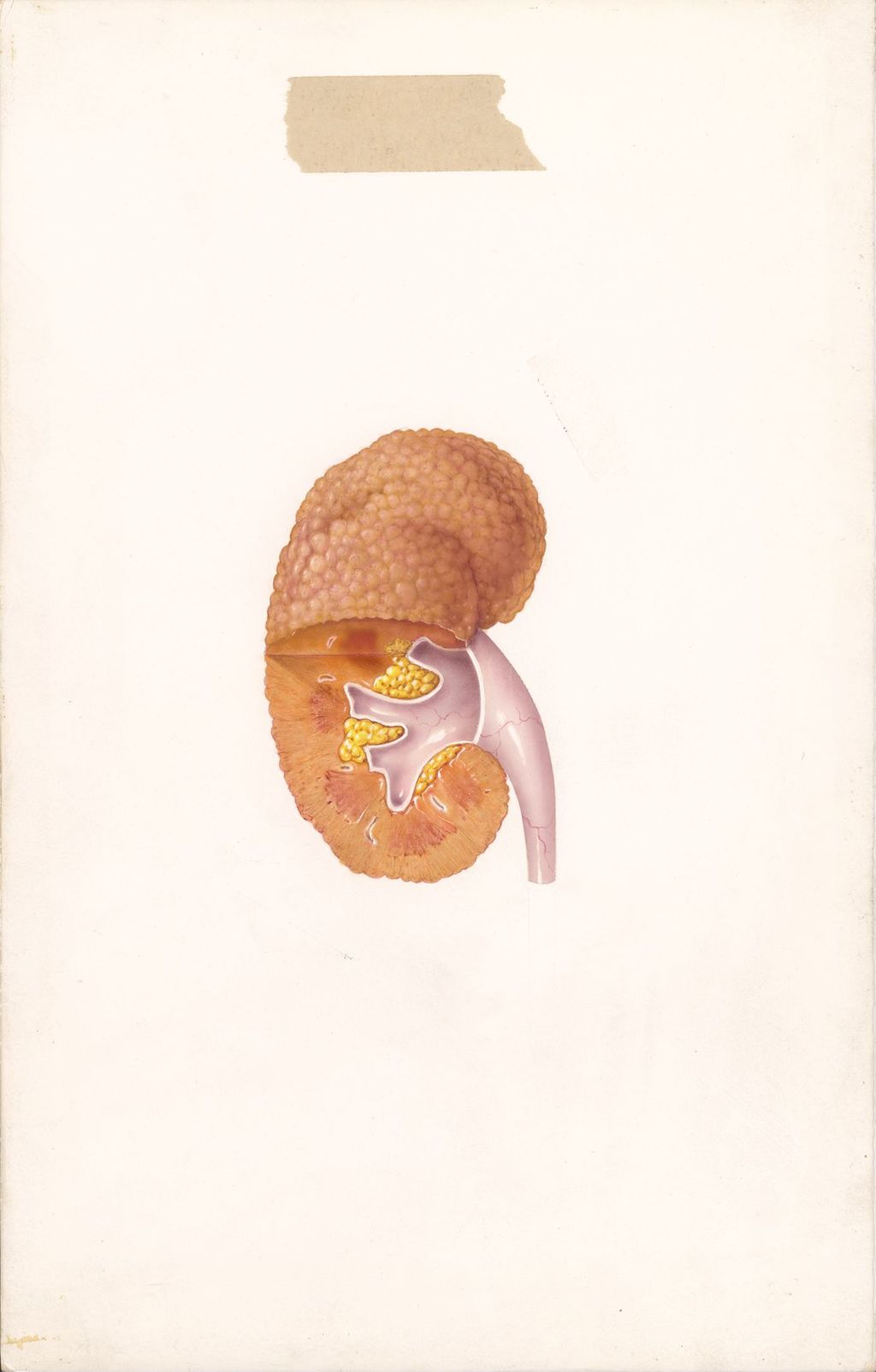 Miniature of Hypertension and the Kidney, Gross Appearance of Chronic Glomerulonephritis