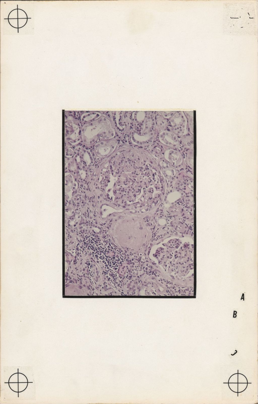 Miniature of Hypertension and the Kidney, Microscopic Portion of Glomerulonephritis