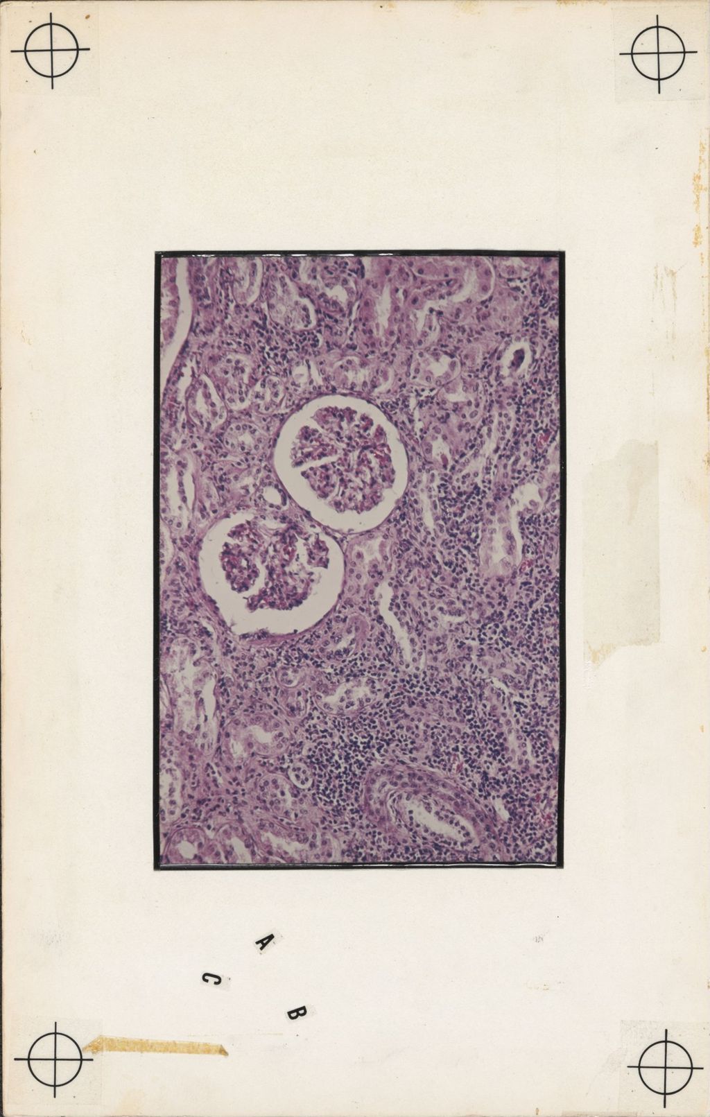 Miniature of Hypertension and the Kidney, Microscopic Portion of Pyelonephritis
