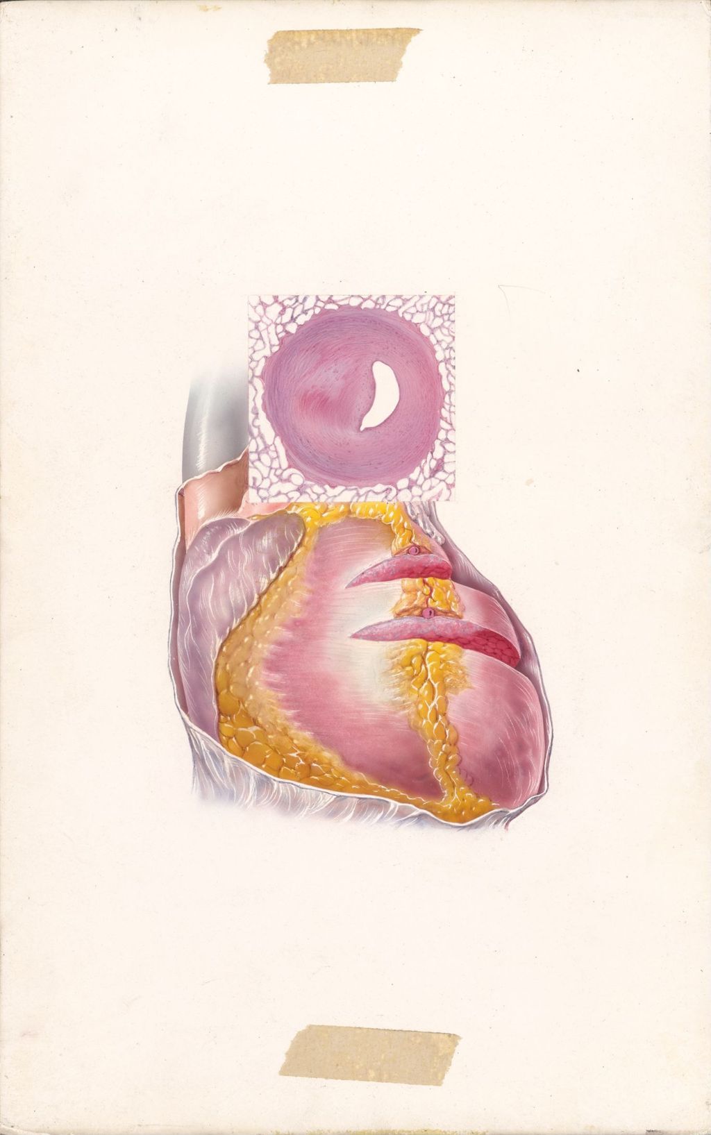Miniature of Edema of Cardiac Origin, Arteriosclerotic Heart Disease