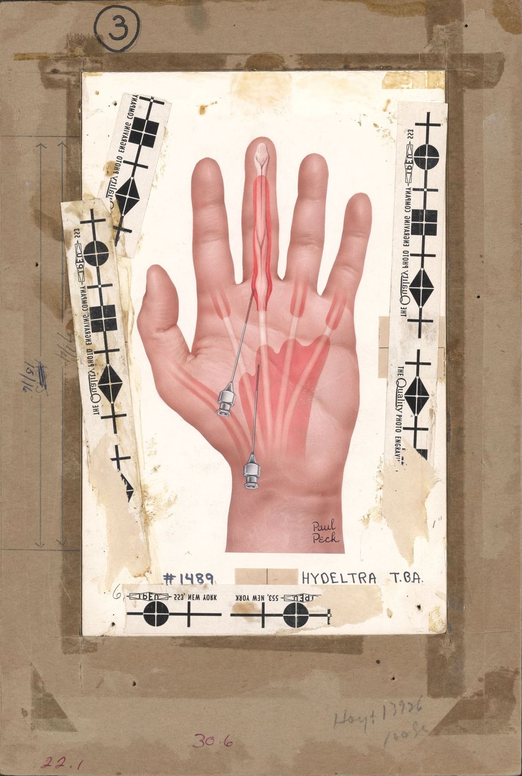 Miniature of Artwork of hand showing needle insertion points in palm and middle finger