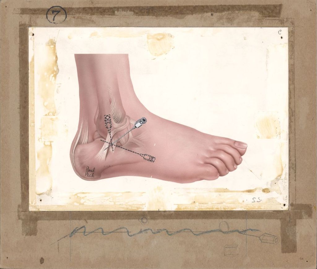 Miniature of Hydeltra TBA, Artwork of foot with needle being inserted into tendons on feet