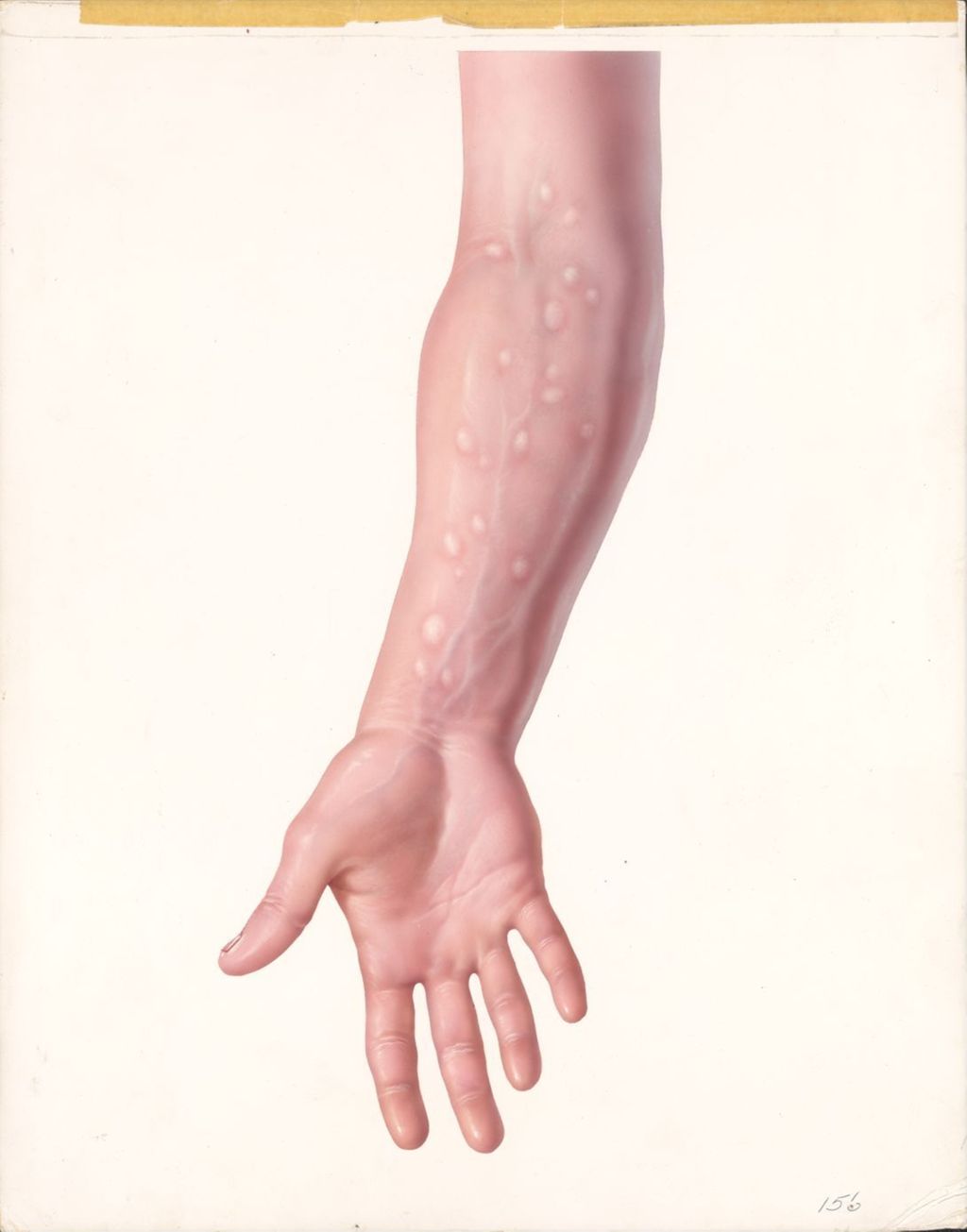 Artwork of arm with veins showing and unknown lumps on arm