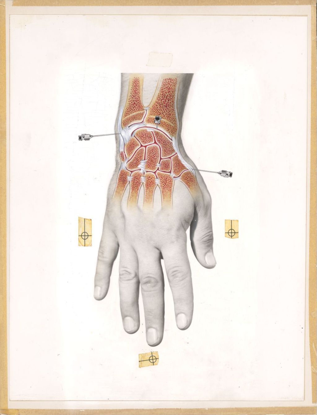 Miniature of Artwork of wrist bones and tendons with needles being inserted, painted over photograph of man's hand