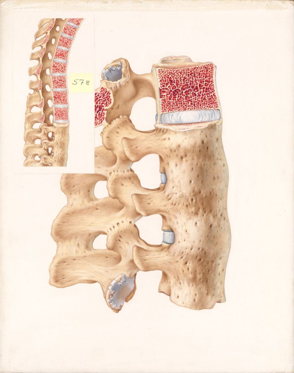 Miniature of Ankylosing Spondylitis