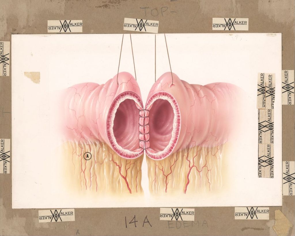 Hydrodiuril in Surgery, illustration 14A