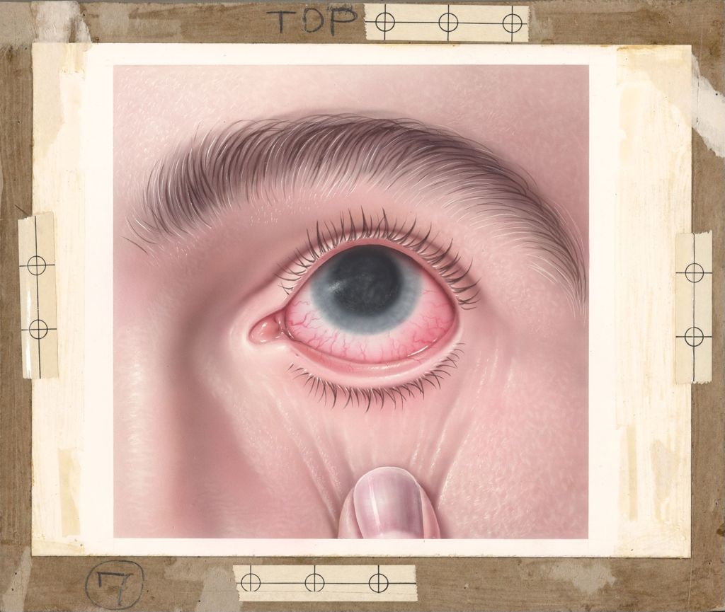 Miniature of Booklet on Common Eye Disorders, Glaucoma